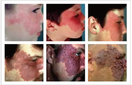 皮肤医生为您解答鲜红斑痣的相关疑惑