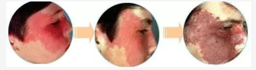 鲜红斑痣科普:皮肤医生带您正确认识鲜红斑痣