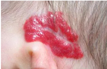 海南胎记治疗:以下四种类型的鲜红斑痣需要注意