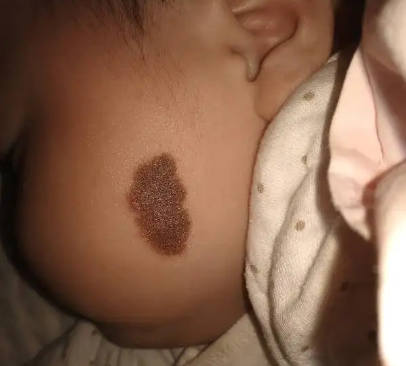 小孩出生之后长褐色胎记需要治疗吗?
