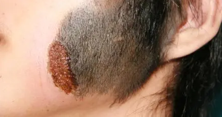 医生,当黑毛痣出现哪些症状时需要及时治疗?