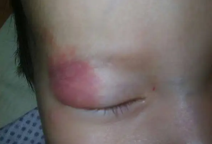 身上为什么会产生胎记,胎记的原因?