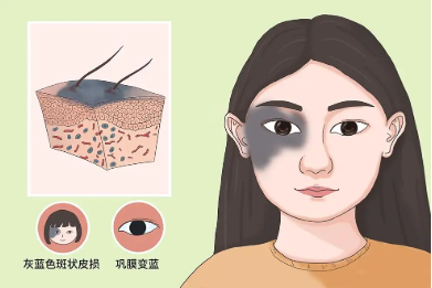 胎记求解:太田痣有哪些表现症状?