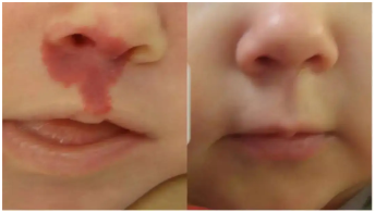 哪些因素会对胎记治疗产生影响?