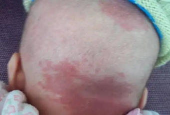 胎记危害,红色胎记会伴随哪些症状?