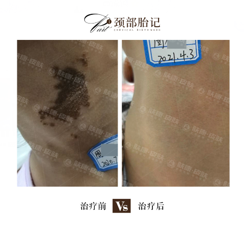 胎记治疗,激光治先天胎记真的有奇效吗?