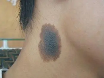 海口医生科普:切除黑毛痣到底有几种方法?