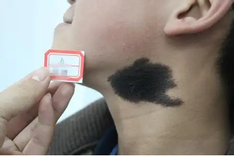 ����֢״�ĺ�ë������Ҫ���Ƶ�,��Ƥ״����֢״��ʲô��