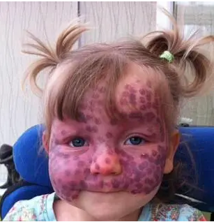 关于胎记病因的神化说法,你有没有中招?