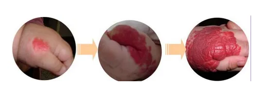 ëϸѪ������������ʲô������ʲô����֢��