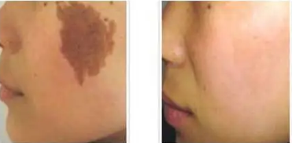 如何才能彻底祛除女性的咖啡色斑?