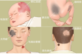 胎记能被治愈吗,治疗胎记三大原则父母一定要知道