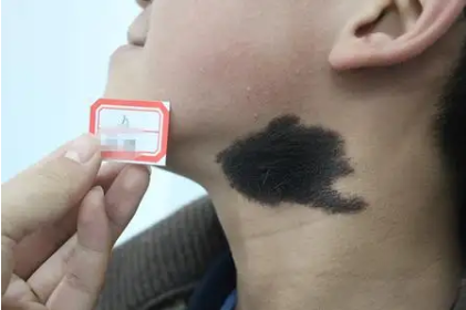 黑色胎记有毛可以祛除吗,用什么方法好?