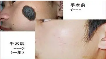 黑毛痣要如何认真对待,才可以治好?