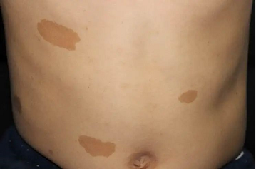 别着急,患有咖啡斑不一定会是神经纤维瘤