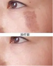 咖啡斑引起的原因,以及治疗方法合集