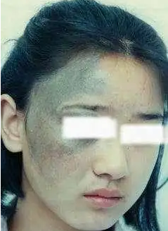 海口肤康,太田痣是什么导致的,症状是什么?