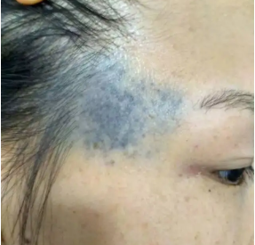 父母担心的问题:太田痣会遗传下一代吗?