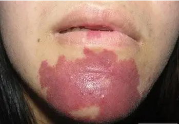 治疗鲜红斑痣时遵守以下原则会好的更快_海口专治鲜红斑痣医院