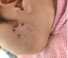 如咖啡斑出现以下症状一定要及时祛除_海南专业治咖啡斑中医院