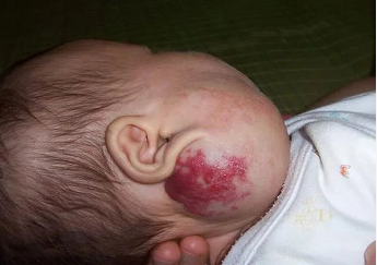 宝宝脸上的红胎记