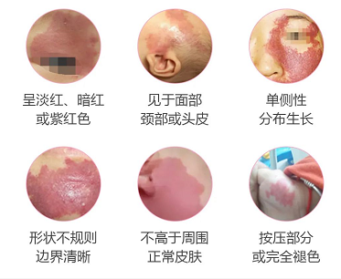 鲜红胎记的不同症状