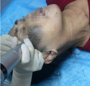 解太田痣的危害有哪些_海口哪家医院治疗胎记