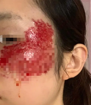 海口皮肤医院治疗太田痣价格是多少_海口激光除胎记费用