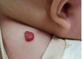 ��ʵ�õ�Ӥ�׶�Ѫ������������_����Ƥ������̥��