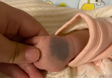 孩子几岁治疗胎记好?海口治胎记医院哪家好