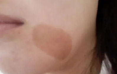 Ϊʲô�����ֿ��Ȱߣ�����ȥ�����Ȱ�ҽԺ