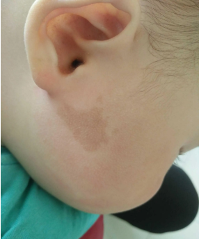 婴儿为什么一出生就有咖啡斑?海口祛胎记医院