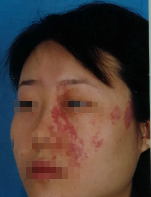 鲜红斑痣遗传给下一代是真的吗?海口胎记治疗医院