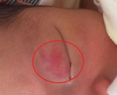 是什麽原因造成胎记增加?海口有治胎记医院吗