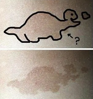 如何区分胎记颜色来辨别胎记种类?海南海口祛除胎记