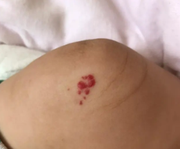婴儿血管瘤导致的主要原因是什么?海口胎记专科医院