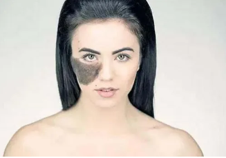 脸上有胎记可以用化妆品遮盖吗?