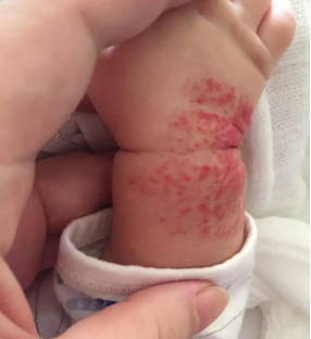 引起婴儿胎记的内外在因素是什么?海口胎记祛除医院