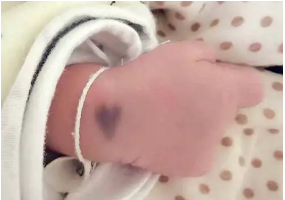 婴儿有胎记需要留着还是祛除?海口激光除胎记