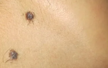 脸上的黑毛痣不治疗会产生恶变吗?海口胎记医院哪家好