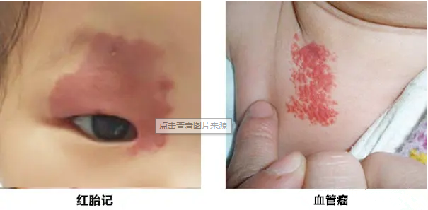 鲜红斑痣是血管瘤吗?二者有何区别?