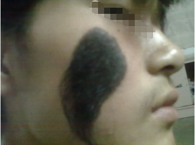 海口激光能去胎记吗