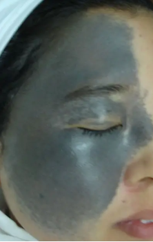 太田痣遗传给儿女的几率是多少?