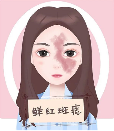 鲜红斑痣
