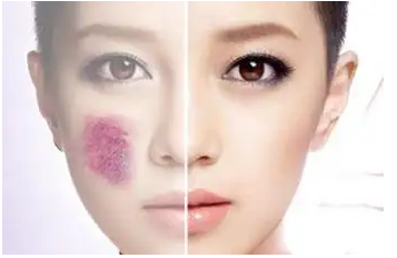 海口胎记激光医院