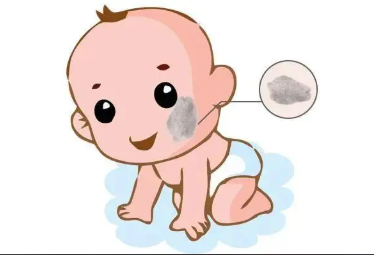 几个月大的婴儿能不能治疗太田痣?