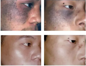  �������ƶ���̥����������Ч�ķ�����