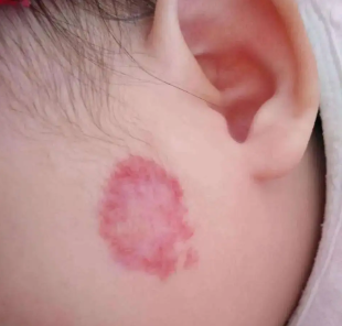 祛除胎记要多少钱?