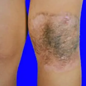 海口治疗黑毛痣效果