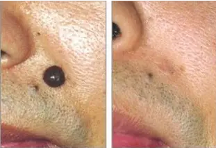 治疗胎记之后如何进行护理?